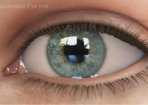 Refractive Errors and Eye Diseases