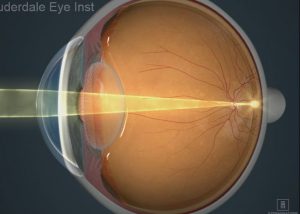 What is a refractive error?