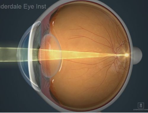What is a Refractive Error