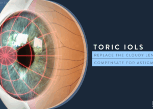 iol toric lens introduction 2 Toridc IOL video image