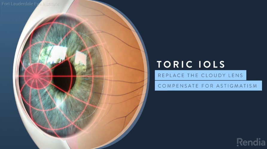 Toridc IOL video image