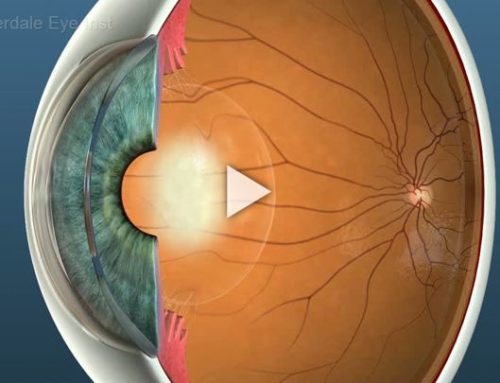 Cataracts: Overview