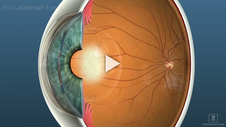 Cataracts Overview
