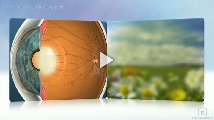 Cataracts Treatment Overview