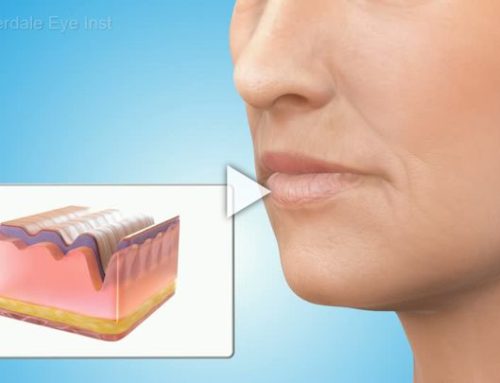 Cosmetic Fillers: Overview