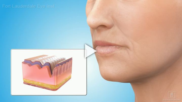 Cosmetic Fillers Overview