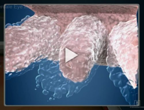 Glaucoma: How Fluid Circulates In The Eye