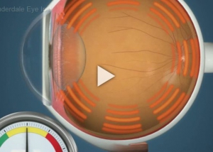 Glaucoma Ocular Hypertension