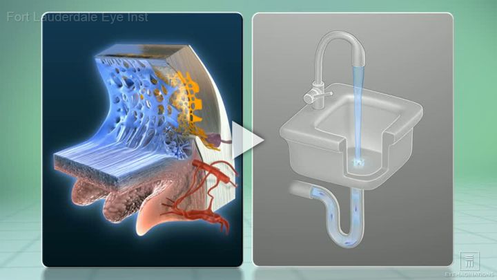 Glaucoma Overview