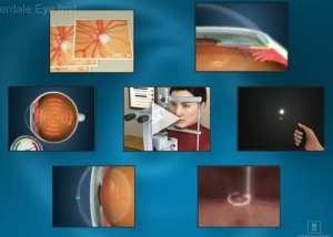 Glaucoma Testing Overview