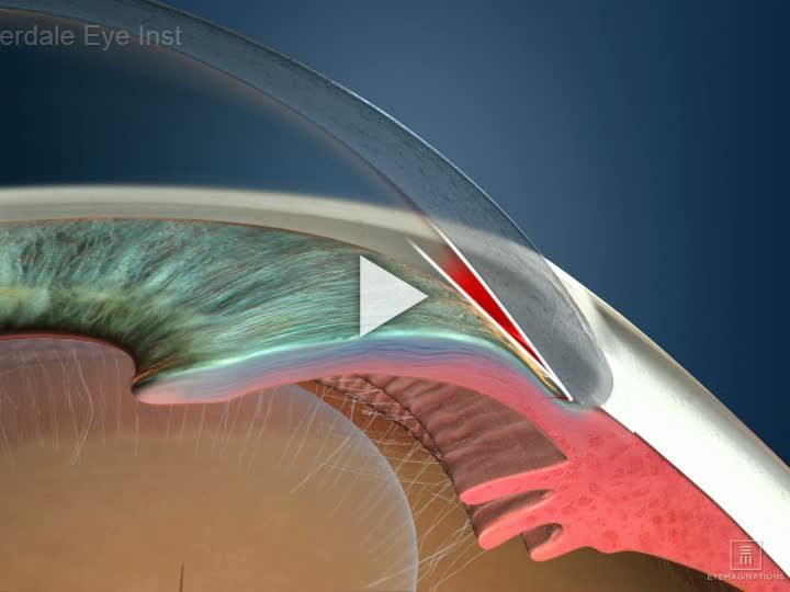 Glaucoma Type Closed Angle