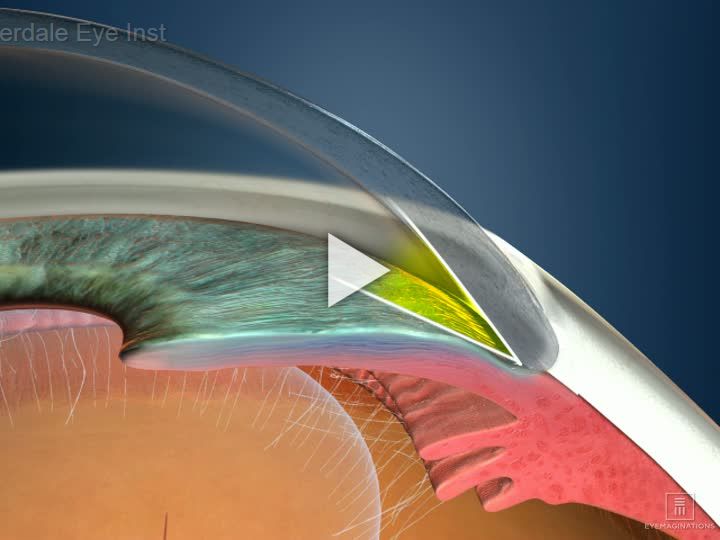 Glaucoma Type Narrow Angle