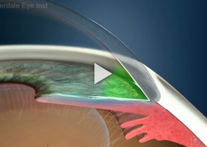 Glaucoma Type Open Angle