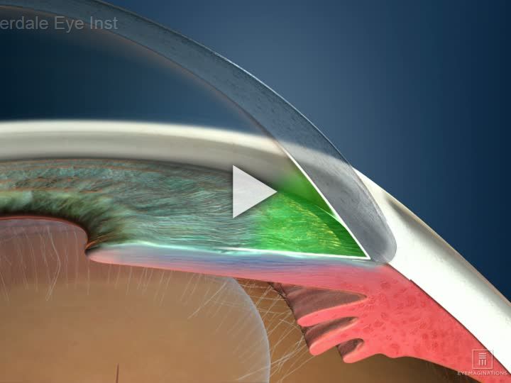 Glaucoma Type Open Angle