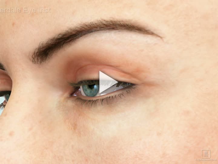 Ptosis Overview