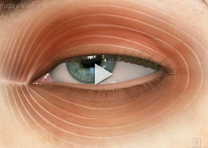 Ptosis Treatment Overview
