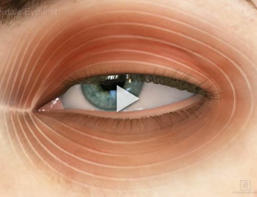 Ptosis: Treatment Overview