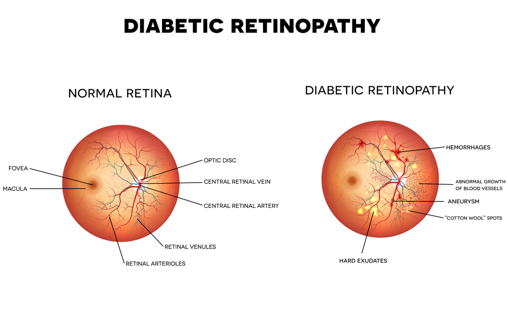 Diabetic Retinopathy Causes And Diagnosis FLEI