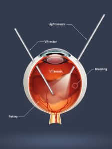 vitrectomy diagram