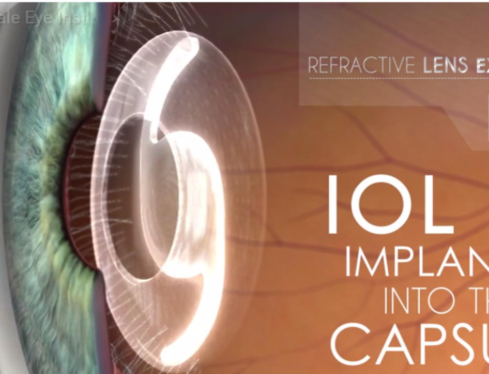 New lens implant to correct astigmatism during cataract surgery Fort