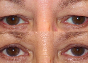 eyelid rejuvenation | upper eyelid blepharoplasty