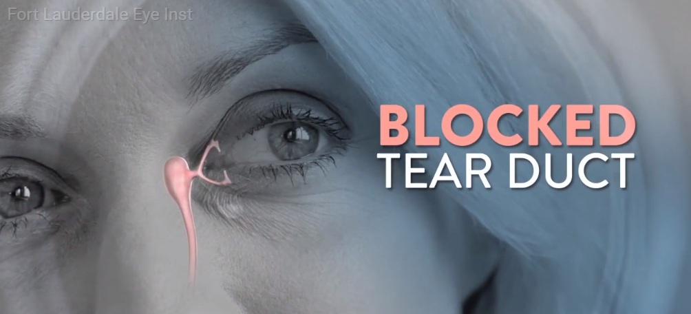 blocked tear duct infection