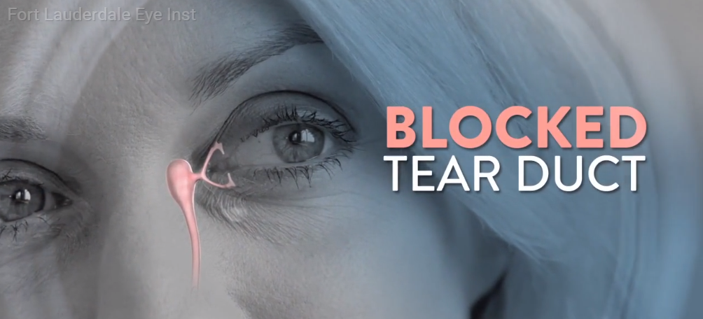 Blocked Tear Duct Causes And Symptoms Fort Lauderdale Eye Institute
