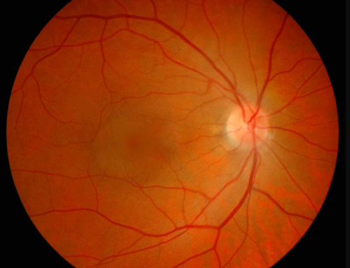 What is Central Serous Retinopathy?