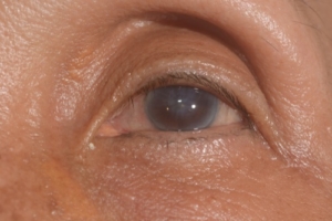corneal edema endothelial dysfunction
