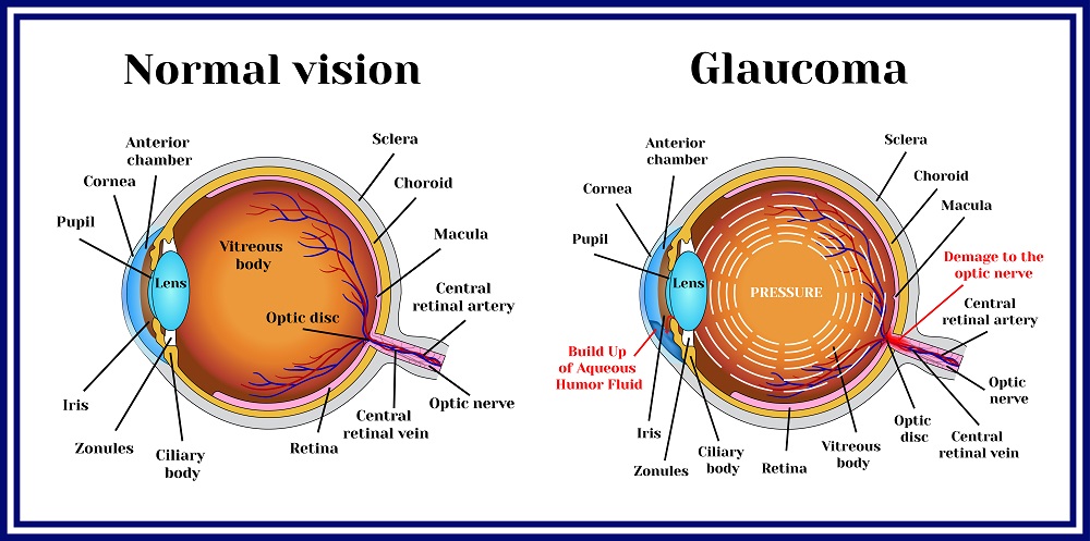 acute angle closure glaucoma