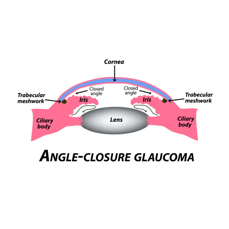 Angle-Closure Glaucoma | Fort Lauderdale Eye Institute