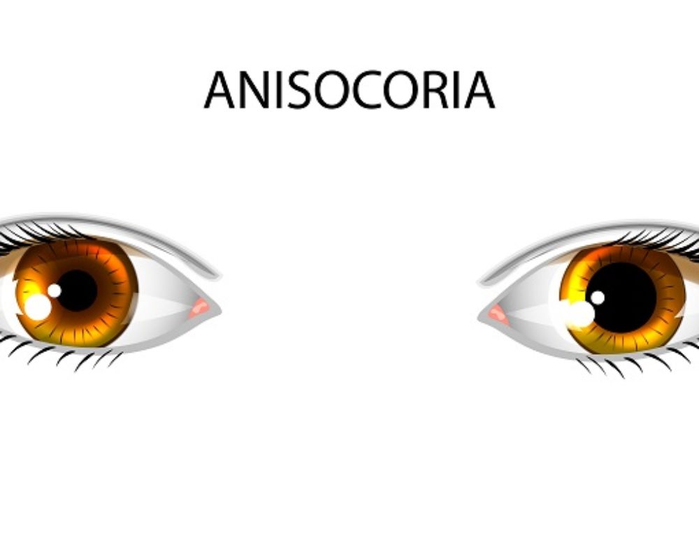 Blepharitis Symptoms and Treatment Fort Lauderdale Eye Institute