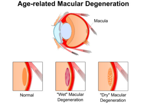 Ways to help Prevent Macular Degeneration