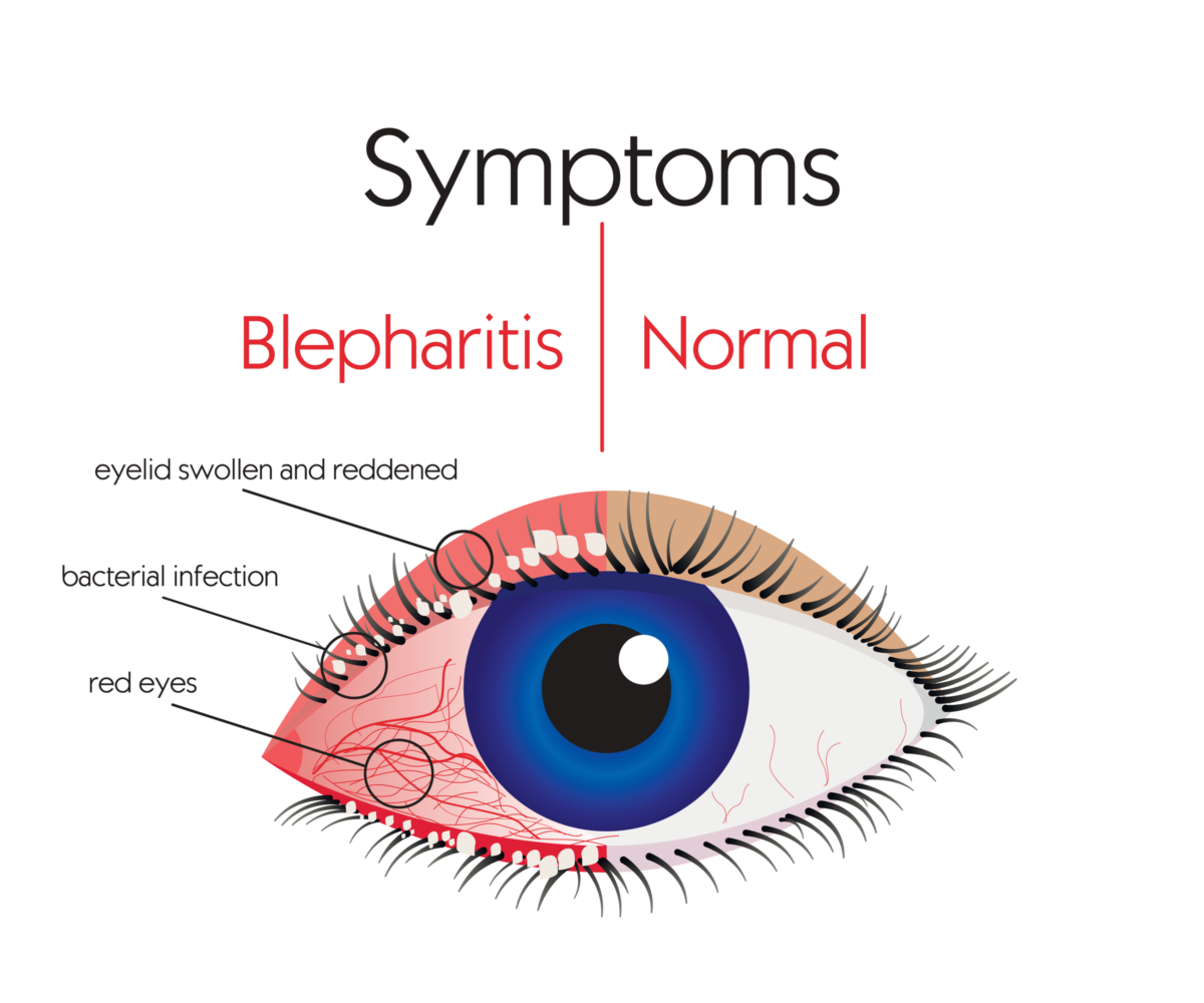 Blepharitis Symptoms And Treatment Fort Lauderdale Eye Institute 