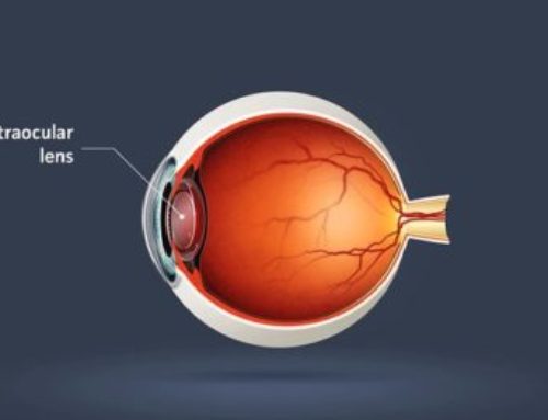 Intraocular Lens Implant (IOL)