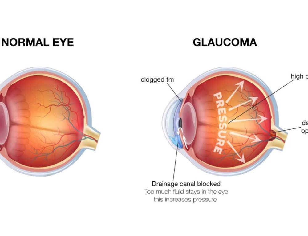 What Are the Symptoms of Narrow Angle Glaucoma? - Fort Lauderdale Eye ...