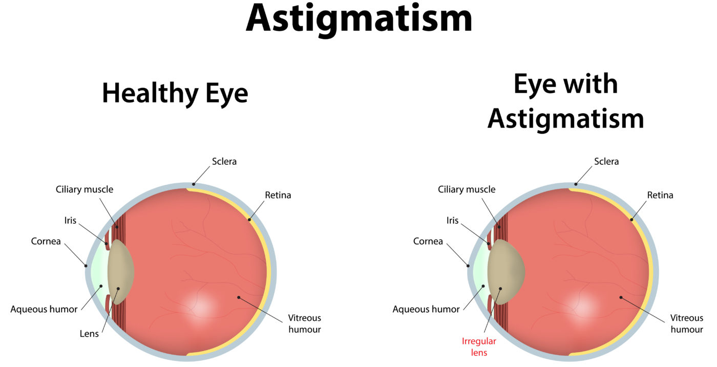 astigmatism vs healthy eyes
