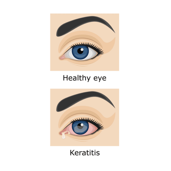 Bacterial Keratitis Overview - Fort Lauderdale Eye Institute