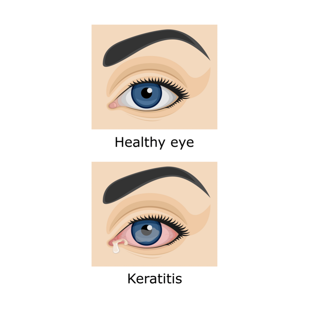 bacterial keratitis vs healthy eye