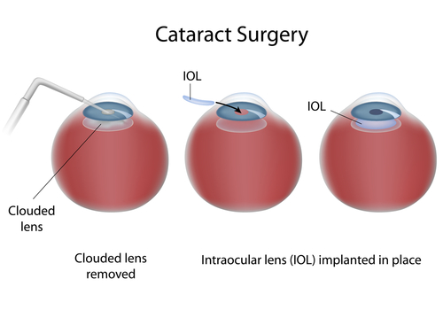 cataract surgery with IOL