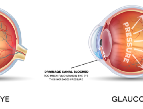 What is Glaucoma?