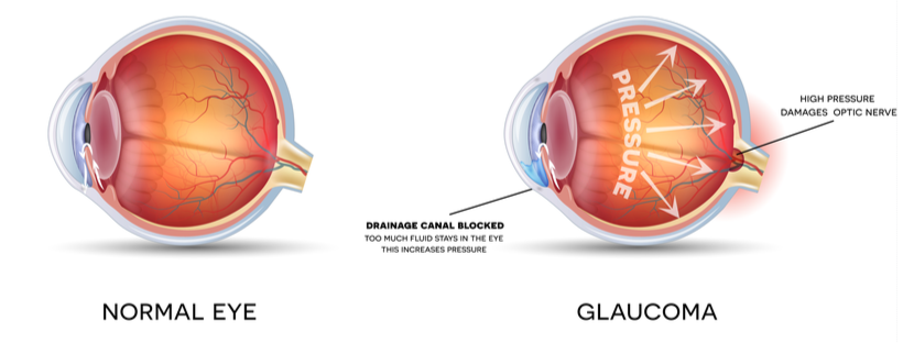 glaucoma showing pressure
