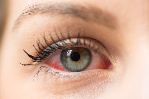 red eye or dry eye allergy