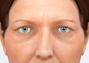 blepharoplasty: overview 26 blepharoplasty overview video cover
