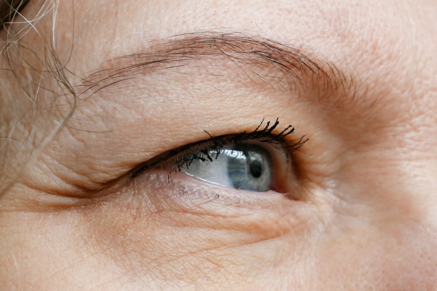 middle aged woman with ptosis eye