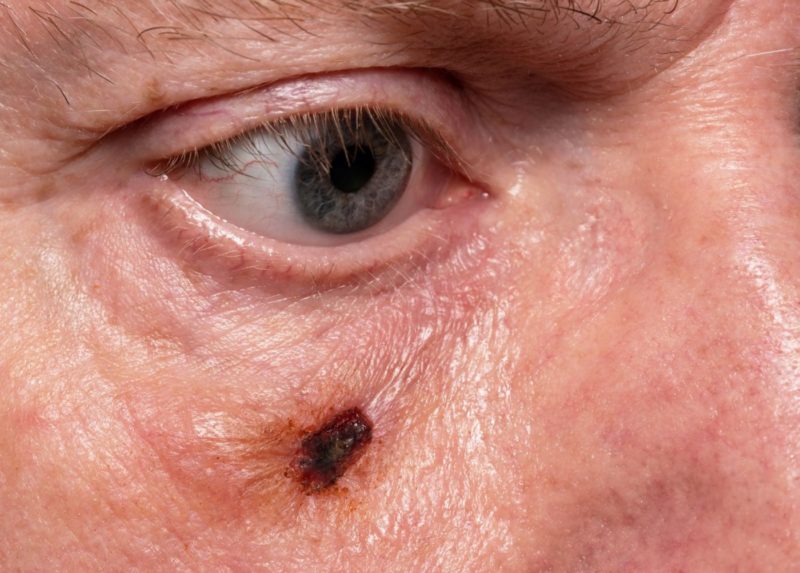eye skin cancer