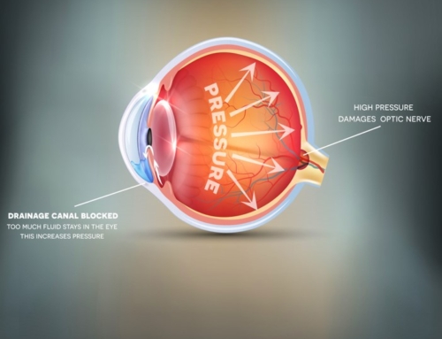 Ocular Hypertension and Glaucoma