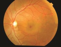 Central Serous Retinopathy Causes & Treatment | Fort Lauderdale Eye ...