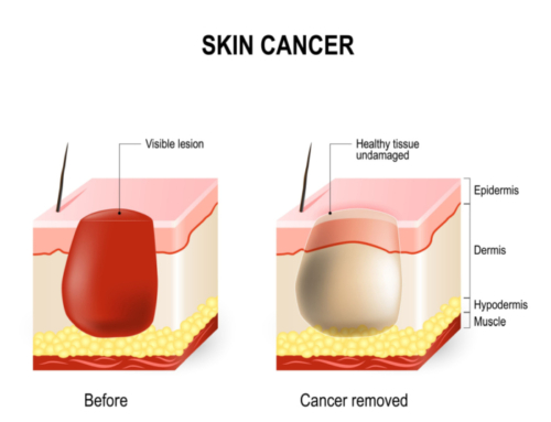 Skin Cancer and Eyelid Reconstruction