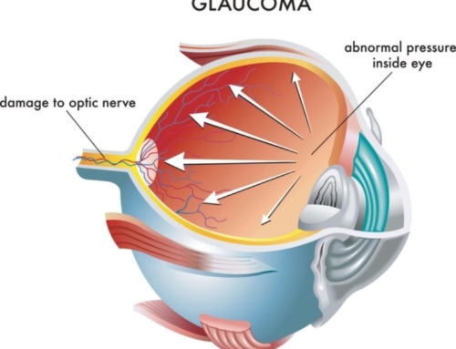 Open-Angle Glaucoma vs Angle-Closure Glaucoma